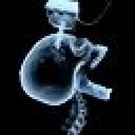 Syringomyelia